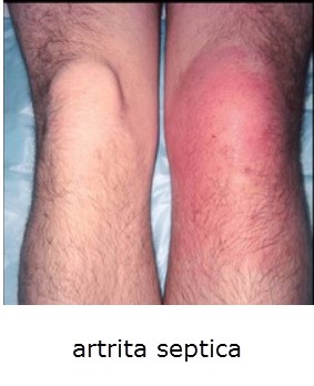 artrita-infectioasa
